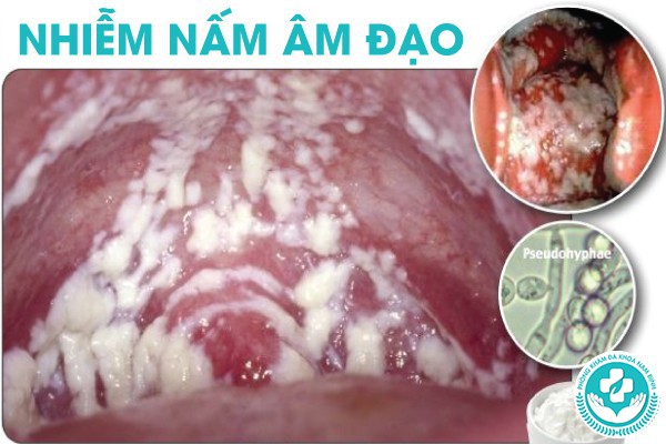 nhiễm nấm âm đạo