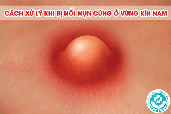 nổi mụn cứng ở vùng kín nam