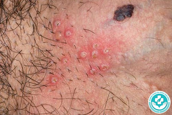 nổi mụn ở bao quy đầu có sao không