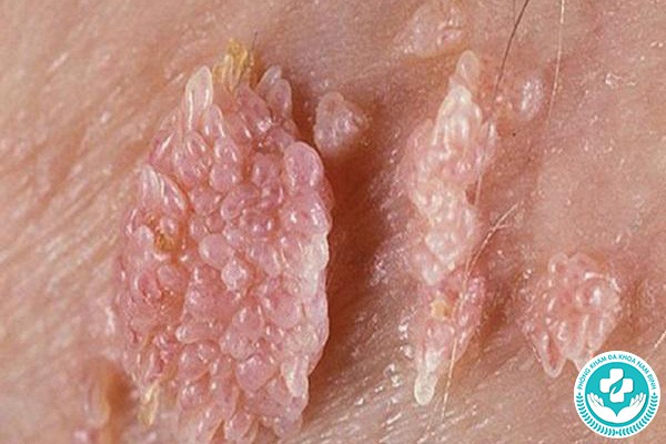 nổi mụn ở vùng kín nữ