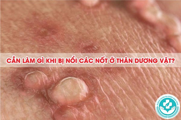 nốt ở thân dương vật 