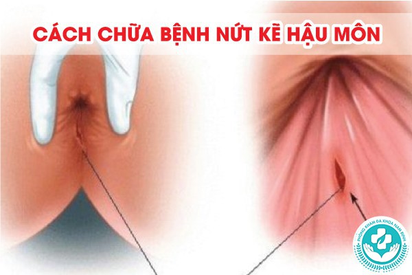 nứt kẽ hậu môn