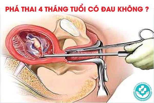 phá thai 4 tháng tuổi có đau không