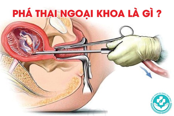 phá thai ngoại khoa là gì