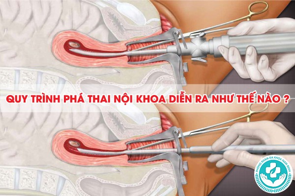 phá thai nội khoa là gì