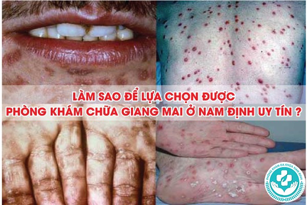 phòng khám chữa giang mai ở nam định