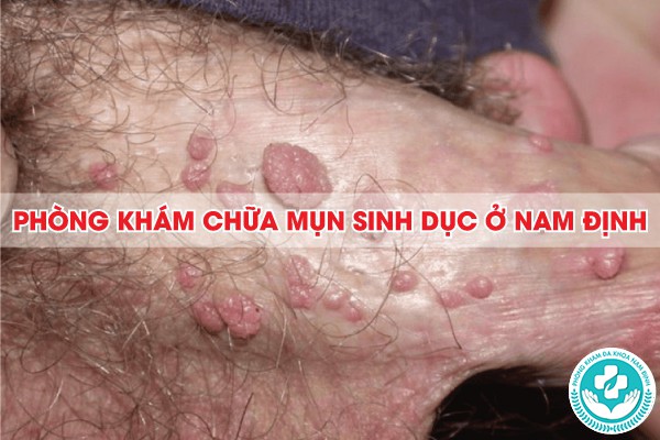 phòng khám chữa mụn sinh dục ở nam định