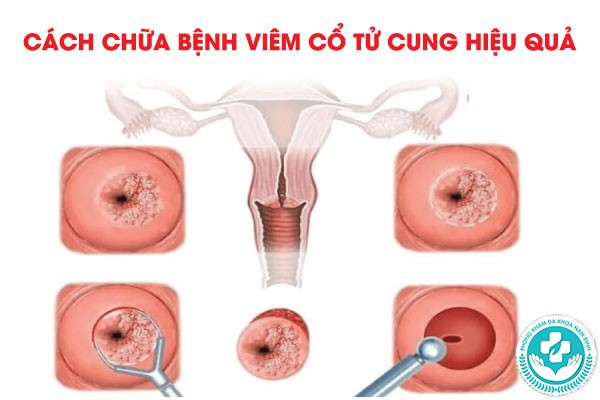 Phòng khám viêm cổ tử cung nam định Phòng khám viêm cổ tử cung nam định