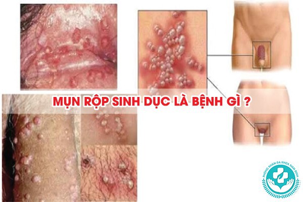 phương pháp chữa mụn rộp sinh dục