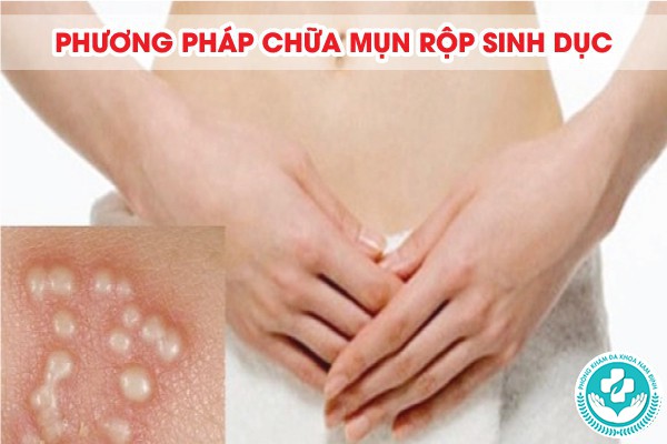 phương pháp chữa mụn rộp sinh dục