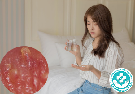 Phương pháp chữa sùi mào gà hiện nay Phương pháp chữa sùi mào gà hiện nay
