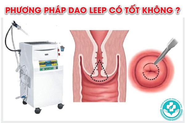 phương pháp dao leep có tốt không