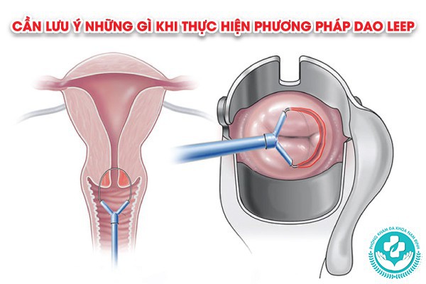 phương pháp dao leep có tốt không