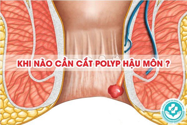polyp hậu môn có nên cắt không