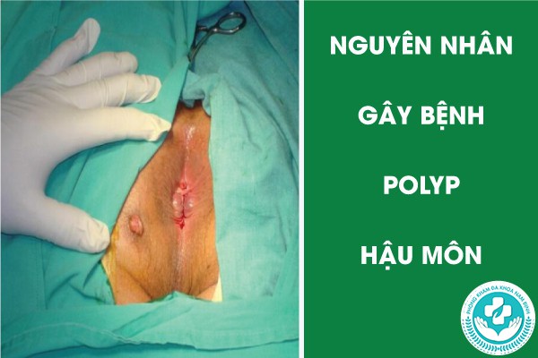 polyp hậu môn là bệnh gì