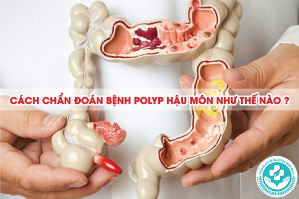 polyp hậu môn nằm ở đâu