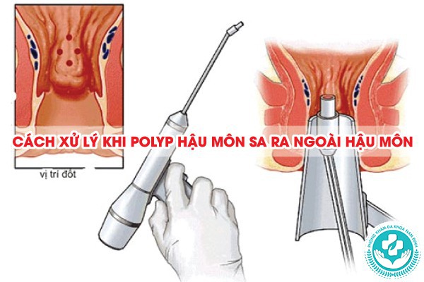 polyp hậu môn sa ra ngoài