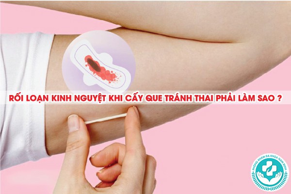 rối loạn kinh nguyệt khi cấy que tránh thai