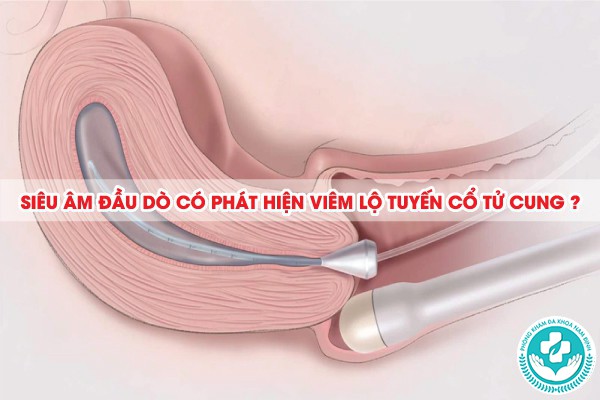 siêu âm đầu dò có phát hiện viêm lộ tuyến