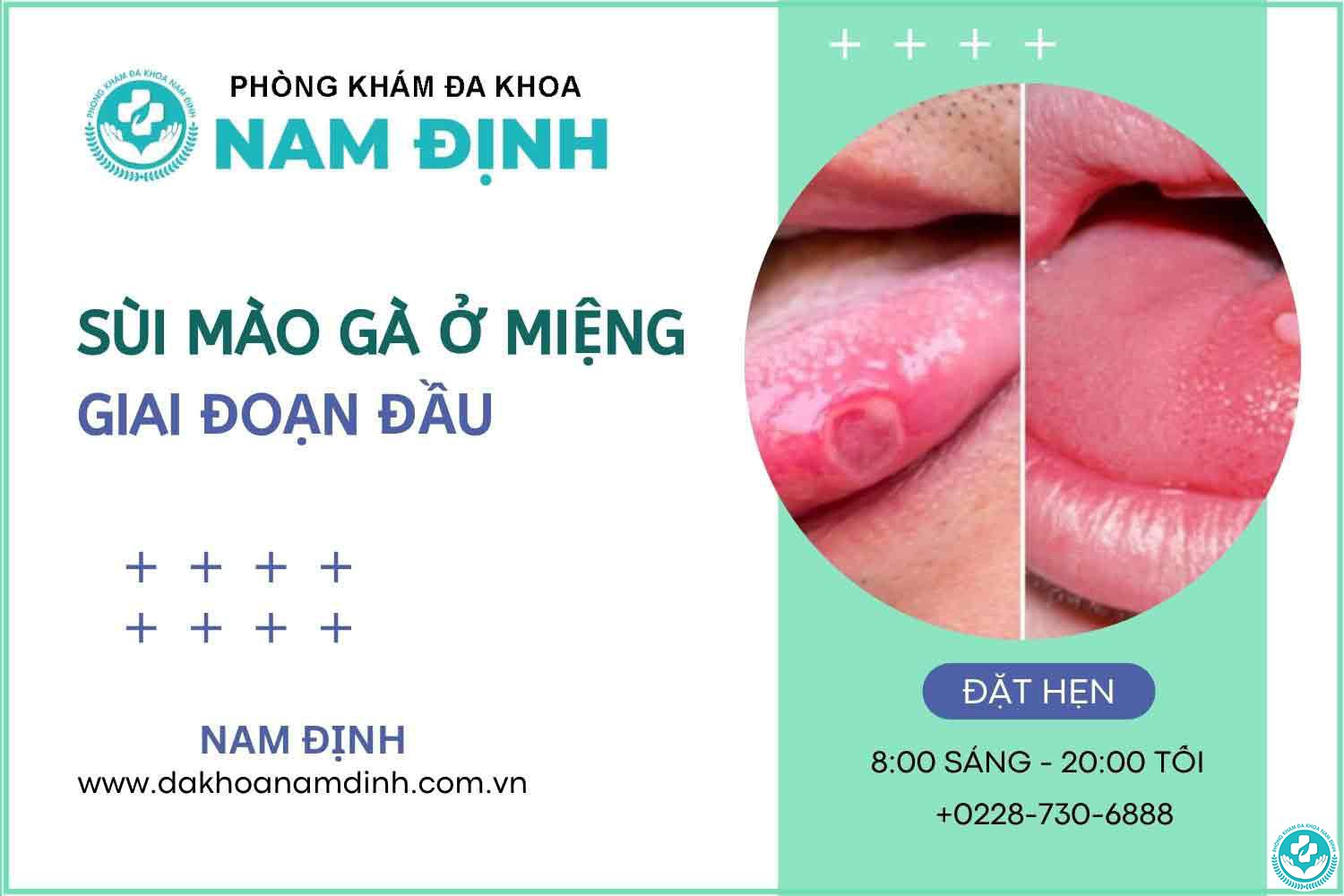 sùi mào gà lây qua nước bọt không