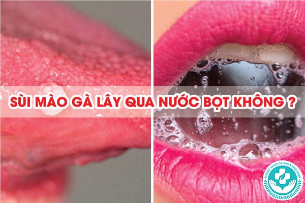 sùi mào gà lây qua nước bọt không