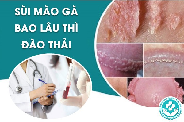 sùi mào gà bao lâu thì đào thải