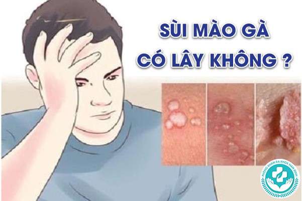 sùi mào gà có lây không