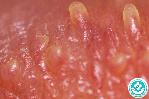 sùi mào gà dễ nhầm lẫn với bệnh gì