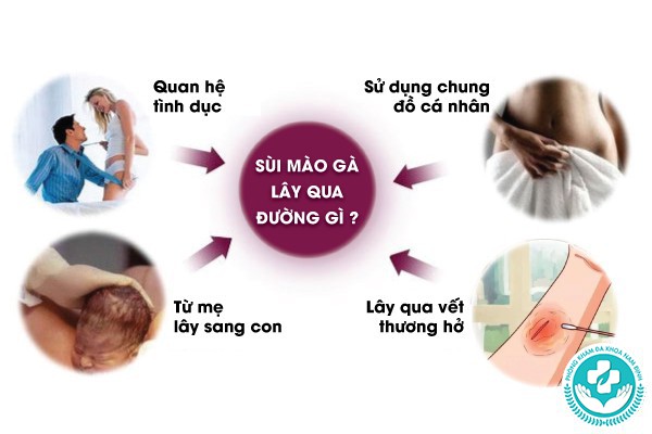 sùi mào gà lây qua đường gì