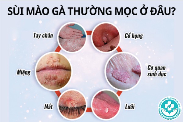 sùi mào gà mọc ở đâu