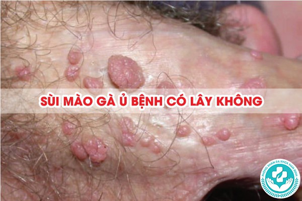 sùi mào gà ủ bệnh có lây không