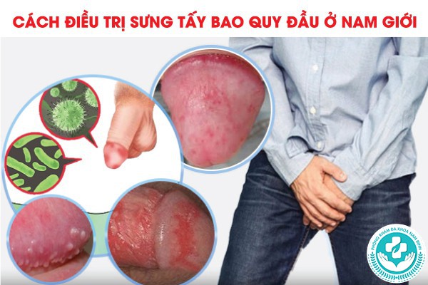 sưng tấy bao quy đầu