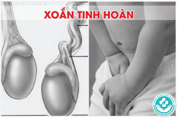 tại sao lại bị xoắn tinh hoàn tại sao lại bị xoắn tinh hoàn