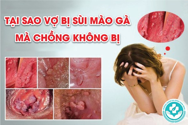 tại sao vợ bị sùi mào gà mà chồng không bị