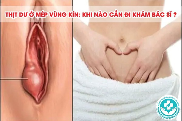 thịt dư ở mép vùng kín