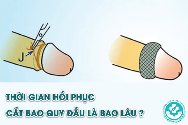 thời gian hồi phục cắt bao quy đầu