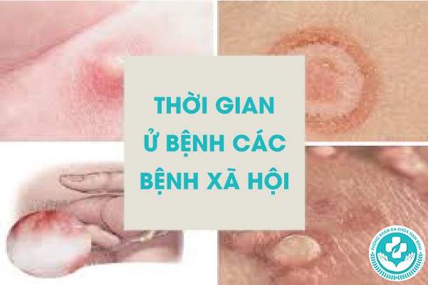 thời gian ủ bệnh các bệnh xã hội