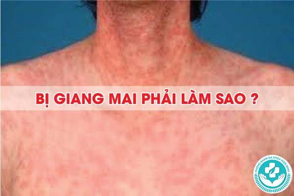 thời gian ủ bệnh của giang mai