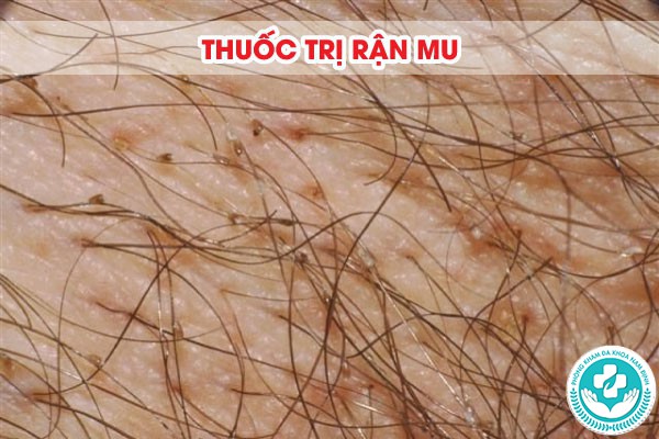 thuốc trị rận mu thuốc trị rận mu