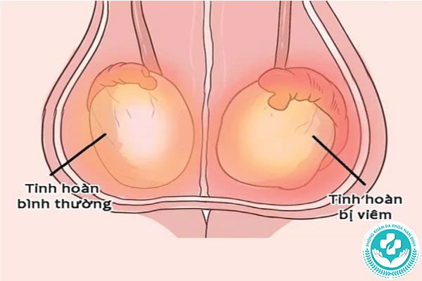 tinh hoàn bên cao bên thấp có sao không