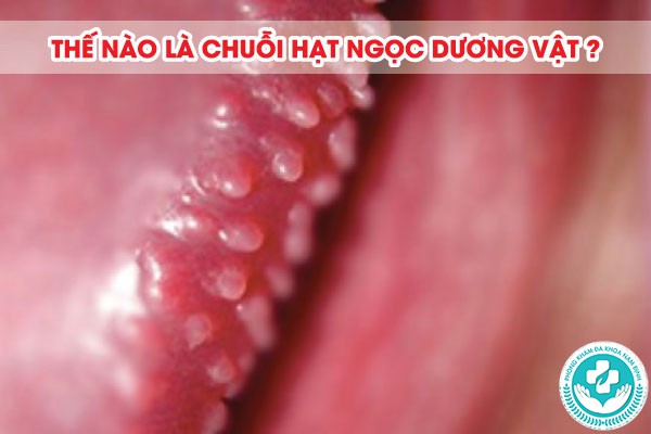 Trị chuỗi hạt ngọc tại nhà