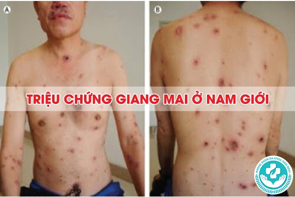 triệu chứng bệnh lậu và giang mai ở nam giới