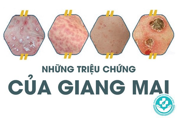 triệu chứng của giang mai