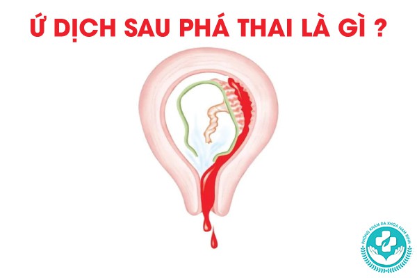 ứ dịch sau phá thai