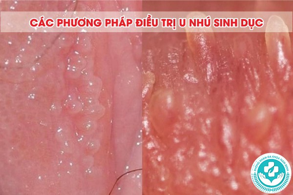 u nhú sinh dục
