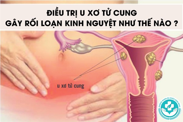 u xơ tử cung gây rối loạn kinh nguyệt