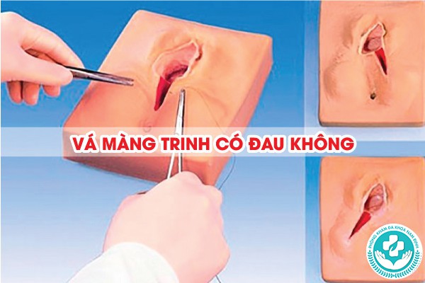 vá màng trinh có đau không