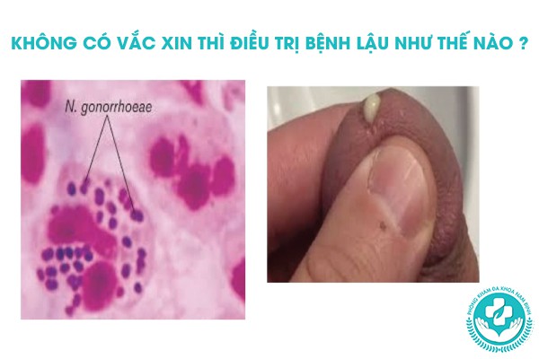 vắc xin bệnh lậu