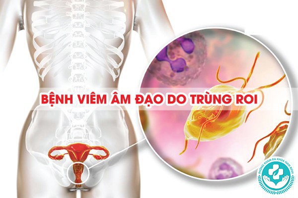 viêm âm đạo do trùng roi