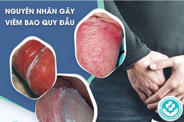 viêm bao quy đầu